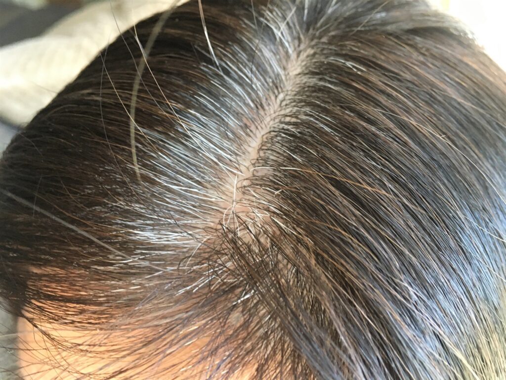 白髪悩み　まとめ